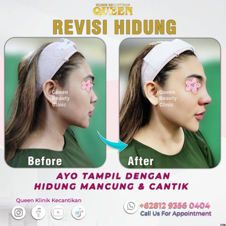 Hasil Rhinoplasty Queen Plastic Surgery, foto 98