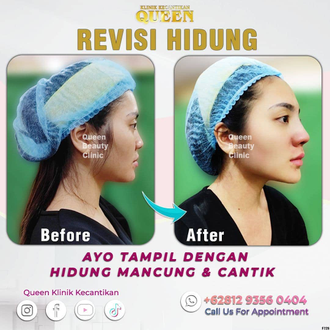 Hasil Rhinoplasty Queen Plastic Surgery, foto 97
