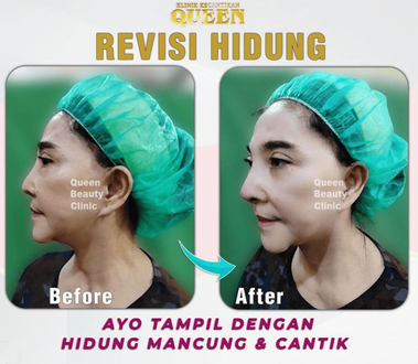 Hasil Rhinoplasty Queen Plastic Surgery, foto 96