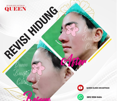 Hasil Rhinoplasty Queen Plastic Surgery, foto 95