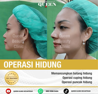 Hasil Rhinoplasty Queen Plastic Surgery, foto 93