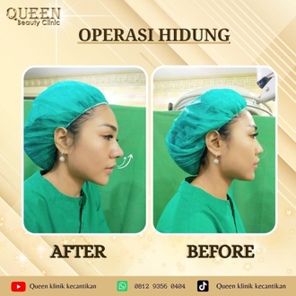 Hasil Rhinoplasty Queen Plastic Surgery, foto 92
