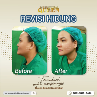 Hasil Rhinoplasty Queen Plastic Surgery, foto 90