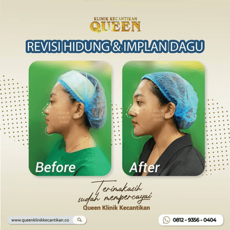 Hasil Rhinoplasty Queen Plastic Surgery, foto 79