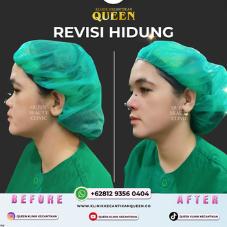 Hasil Rhinoplasty Queen Plastic Surgery, foto 78