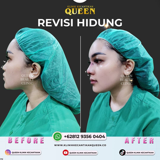 Hasil Rhinoplasty Queen Plastic Surgery, foto 80