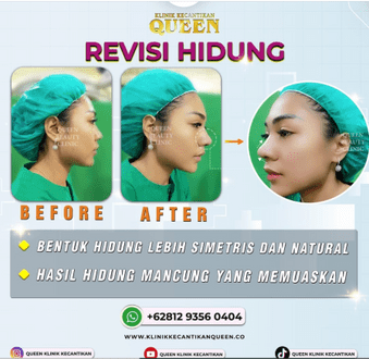 Hasil Rhinoplasty Queen Plastic Surgery, foto 81