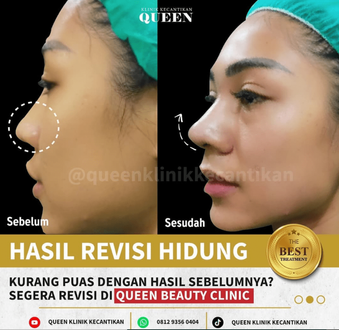Hasil Rhinoplasty Queen Plastic Surgery, foto 82