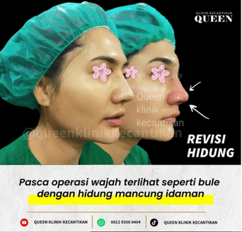 Hasil Rhinoplasty Queen Plastic Surgery, foto 83