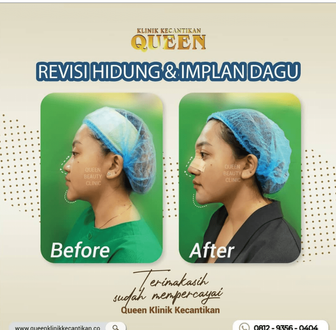 Hasil Rhinoplasty Queen Plastic Surgery, foto 84
