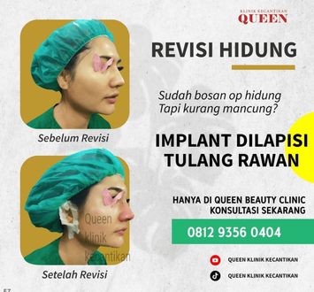 Hasil Rhinoplasty Queen Plastic Surgery, foto 85