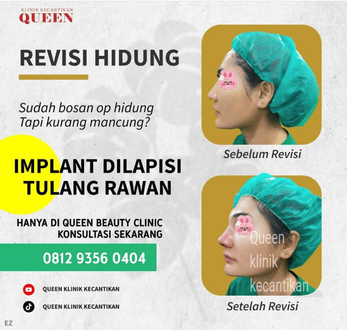 Hasil Rhinoplasty Queen Plastic Surgery, foto 86