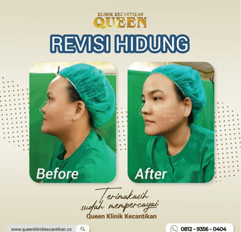 Hasil Rhinoplasty Queen Plastic Surgery, foto 87