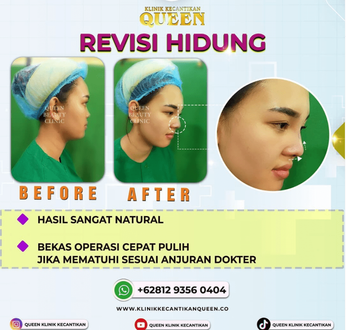 Hasil Rhinoplasty Queen Plastic Surgery, foto 77