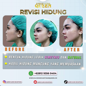Hasil Rhinoplasty Queen Plastic Surgery, foto 76