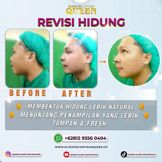 Hasil Rhinoplasty Queen Plastic Surgery, foto 75