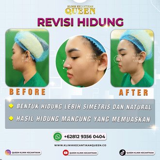 Hasil Rhinoplasty Queen Plastic Surgery, foto 73