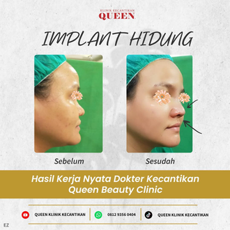 Hasil Rhinoplasty Queen Plastic Surgery, foto 72