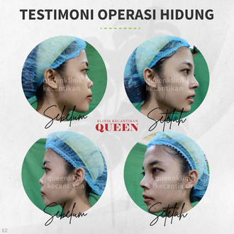 Hasil Rhinoplasty Queen Plastic Surgery, foto 70
