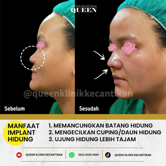 Hasil Rhinoplasty Queen Plastic Surgery, foto 69