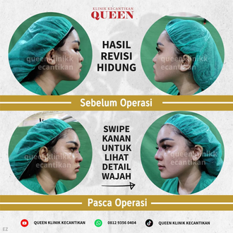 Hasil Rhinoplasty Queen Plastic Surgery, foto 68