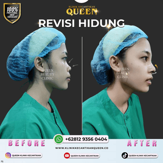 Hasil Rhinoplasty Queen Plastic Surgery, foto 66