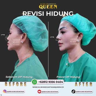 Hasil Rhinoplasty Queen Plastic Surgery, foto 54