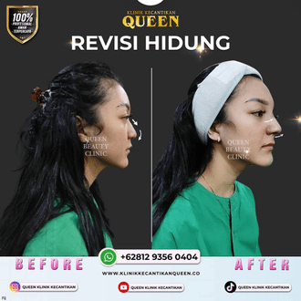 Hasil Rhinoplasty Queen Plastic Surgery, foto 55