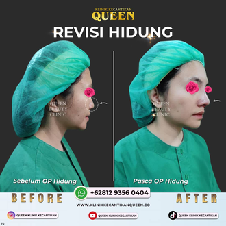 Hasil Rhinoplasty Queen Plastic Surgery, foto 56