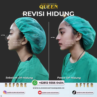Hasil Rhinoplasty Queen Plastic Surgery, foto 57