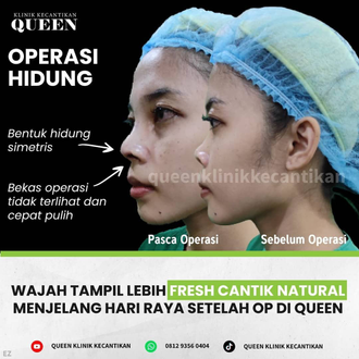 Hasil Rhinoplasty Queen Plastic Surgery, foto 58