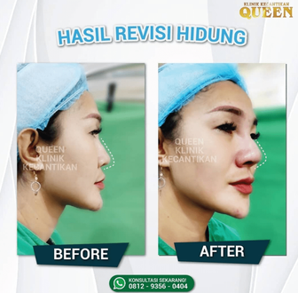Hasil Rhinoplasty Queen Plastic Surgery, foto 61