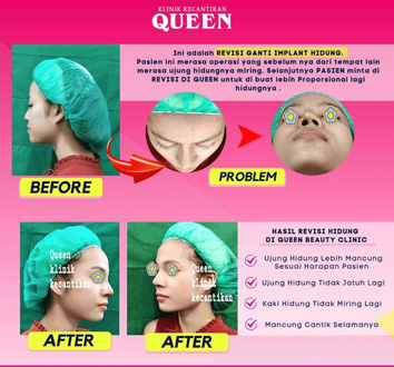 Hasil Rhinoplasty Queen Plastic Surgery, foto 62