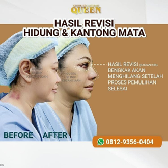Hasil Rhinoplasty Queen Plastic Surgery, foto 63