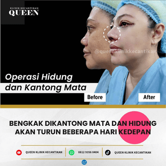 Hasil Rhinoplasty Queen Plastic Surgery, foto 65