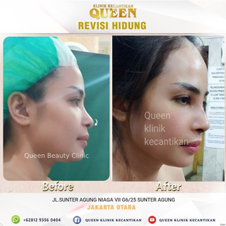 Hasil Rhinoplasty Queen Plastic Surgery, foto 48