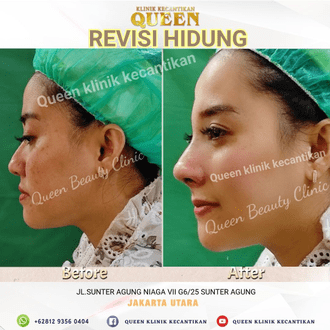 Hasil Rhinoplasty Queen Plastic Surgery, foto 46