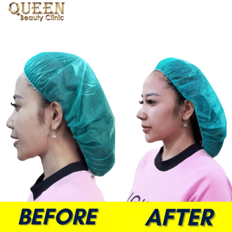 Hasil Rhinoplasty Queen Plastic Surgery, foto 43