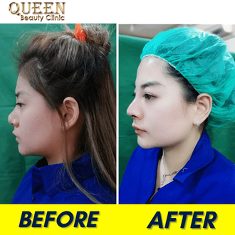 Hasil Rhinoplasty Queen Plastic Surgery, foto 42