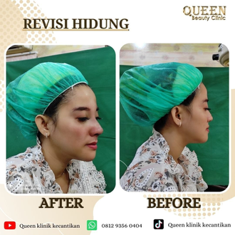 Hasil Rhinoplasty Queen Plastic Surgery, foto 35