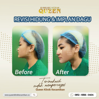 Hasil Rhinoplasty Queen Plastic Surgery, foto 36