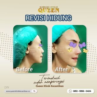 Hasil Rhinoplasty Queen Plastic Surgery, foto 37