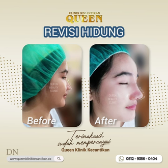 Hasil Rhinoplasty Queen Plastic Surgery, foto 38