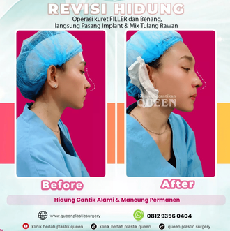 Hasil Rhinoplasty Queen Plastic Surgery, foto 5