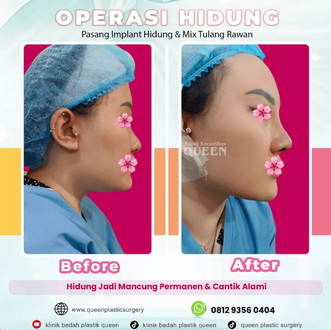 Hasil Rhinoplasty Queen Plastic Surgery, foto 6