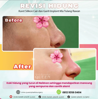 Hasil Rhinoplasty Queen Plastic Surgery, foto 4
