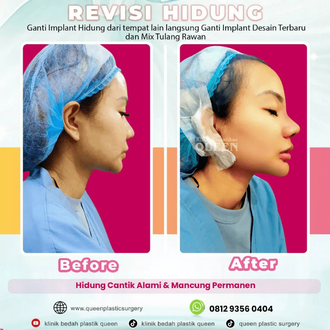 Hasil Rhinoplasty Queen Plastic Surgery, foto 3