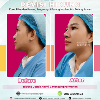 Hasil Rhinoplasty Queen Plastic Surgery, foto 2