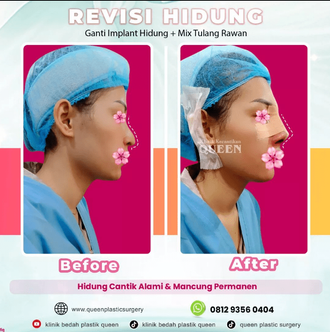 Hasil Rhinoplasty Queen Plastic Surgery, foto 1