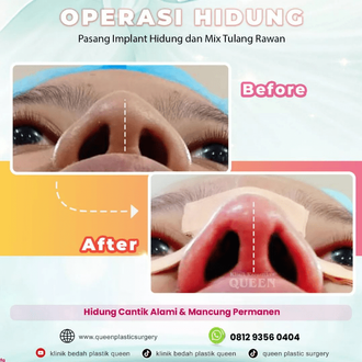 Hasil Rhinoplasty Queen Plastic Surgery, foto 100